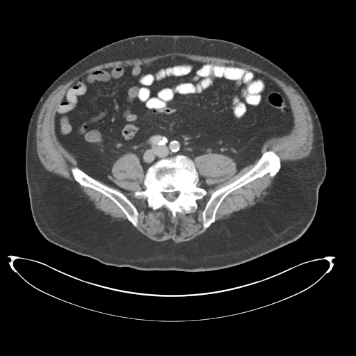 Adenocarcioma of rectum- T1 lesion (Radiopaedia 36921-38547 Axial C+ portal venous phase 59).png