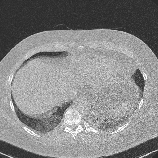 File:Adenoid cystic carcinoma of the trachea (Radiopaedia 49042-54137 Axial lung window 277).jpg