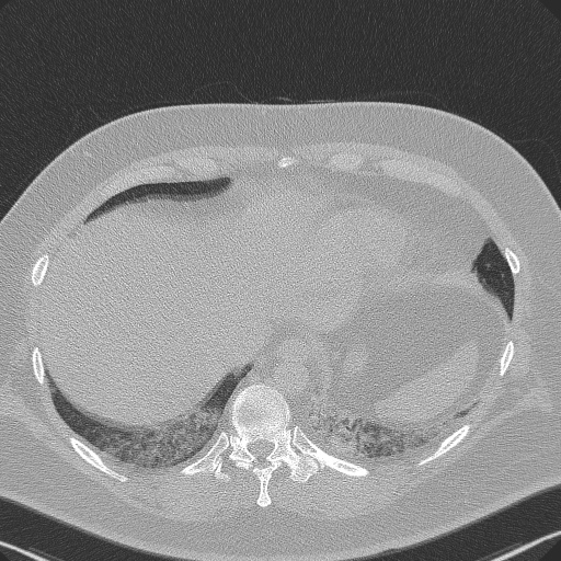 Adenoid cystic carcinoma of the trachea (Radiopaedia 49042-54137 Axial lung window 285).jpg