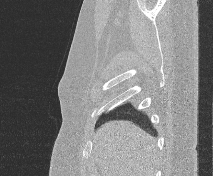 Adenoid cystic carcinoma of the trachea (Radiopaedia 49042-54137 Sagittal lung window 43).jpg