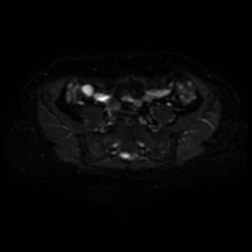 Adenoma malignum of cervix (Radiopaedia 66441-75705 Axial DWI 1).jpg