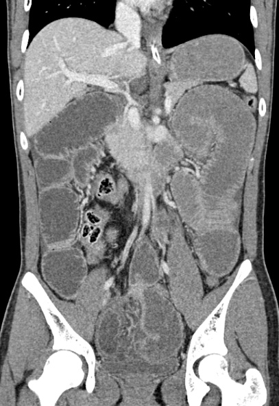 Adhesional small bowel obstruction (Radiopaedia 52107-57980 Coronal C+ portal venous phase 41).jpg