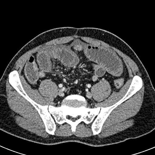 Adhesional small bowel obstruction (Radiopaedia 58900-66131 Axial C+ portal venous phase 39).jpg