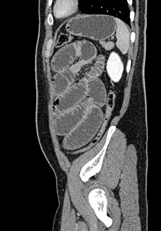 Adhesional small bowel obstruction (Radiopaedia 58900-66131 Sagittal C+ portal venous phase 203).jpg