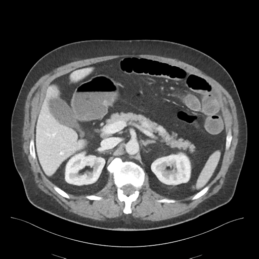 Adhesions within abdominal wall hernia (Radiopaedia 58283-65394 Axial C+ portal venous phase 29).png