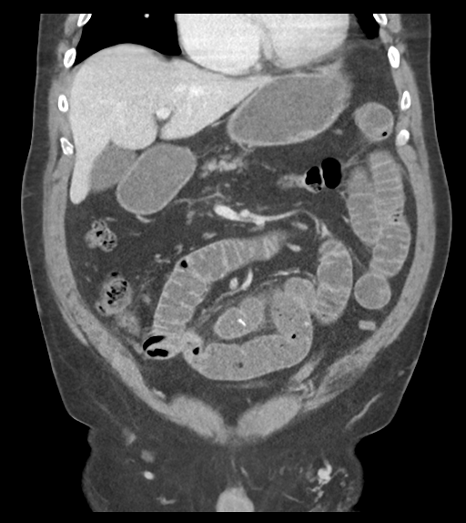 Adhesions within abdominal wall hernia (Radiopaedia 58283-65394 Coronal C+ portal venous phase 29).png