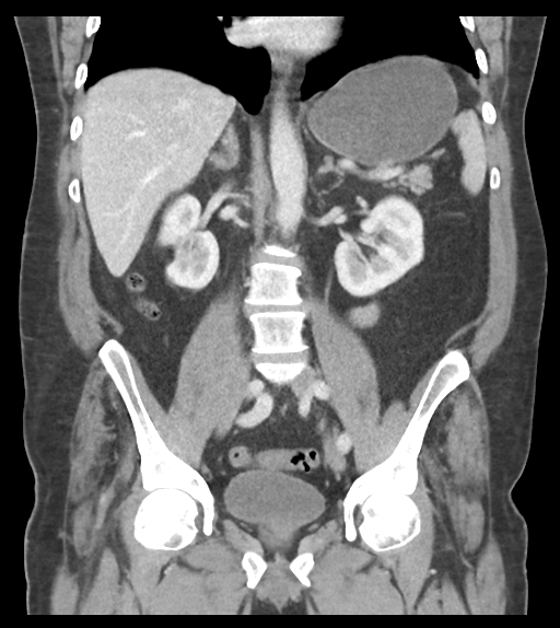 Adhesions within abdominal wall hernia (Radiopaedia 58283-65394 Coronal C+ portal venous phase 42).png