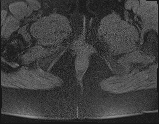 File:Adnexal multilocular cyst (O-RADS US 3. O-RADS MRI 3) (Radiopaedia 87426-103754 Axial 228).jpeg