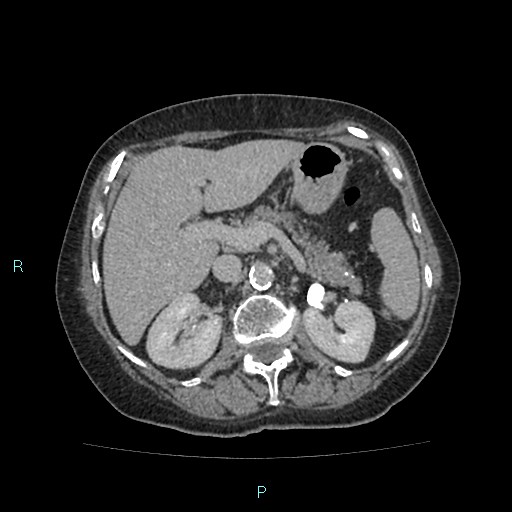 File:Adrenal collision tumor (ACT) (Radiopaedia 48462-53379 Axial C+ delayed 21).jpg
