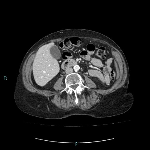 File:Adrenal collision tumor (ACT) (Radiopaedia 48462-53379 Axial C+ portal venous phase 31).jpg