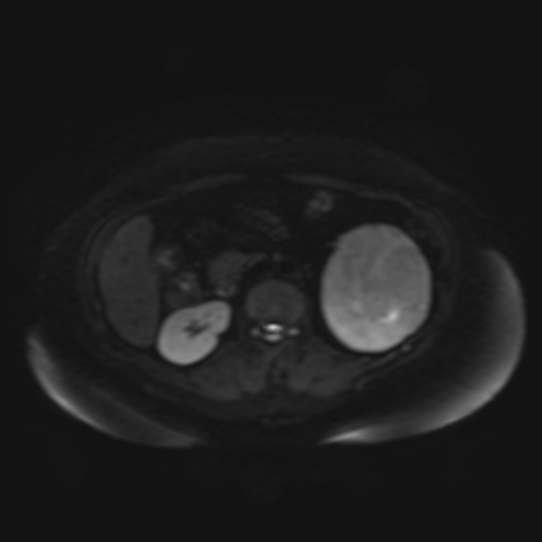 Adrenal cortical carcinoma (Radiopaedia 70906-81116 Axial DWI 16).jpg