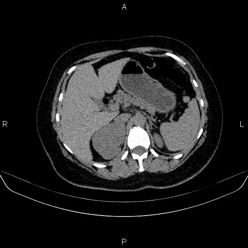 File:Adrenal cortical carcinoma (Radiopaedia 84882-100379 Axial non-contrast 25).jpg