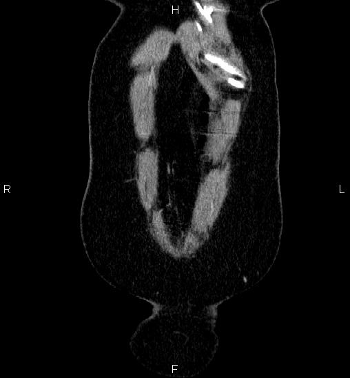 Adrenal cortical carcinoma (Radiopaedia 84882-100379 Coronal C+ portal venous phase 2).jpg