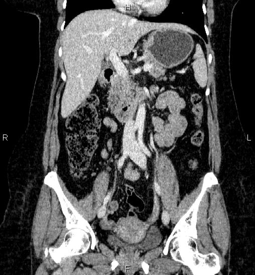 Adrenal cortical carcinoma (Radiopaedia 84882-100379 Coronal C+ portal venous phase 30).jpg