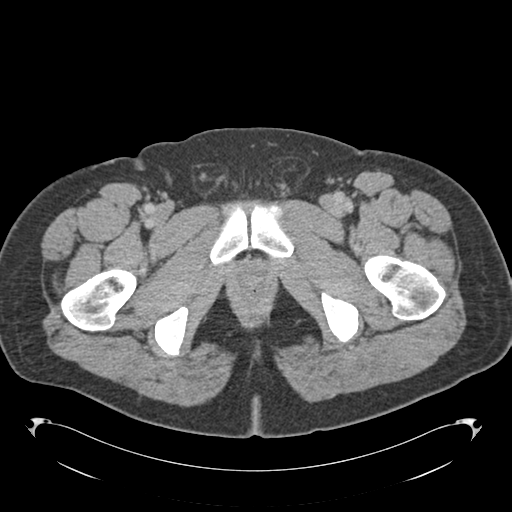 Adrenal cyst (Radiopaedia 45625-49776 Axial C+ portal venous phase 101).png
