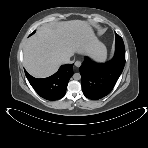 Adrenal cyst (Radiopaedia 45625-49778 Axial non-contrast 4).png