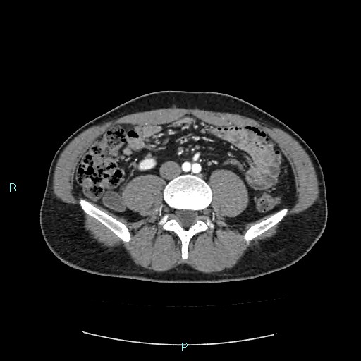 Adrenal cystic lymphangioma (Radiopaedia 83161-97534 Axial C+ arterial phase 59).jpg