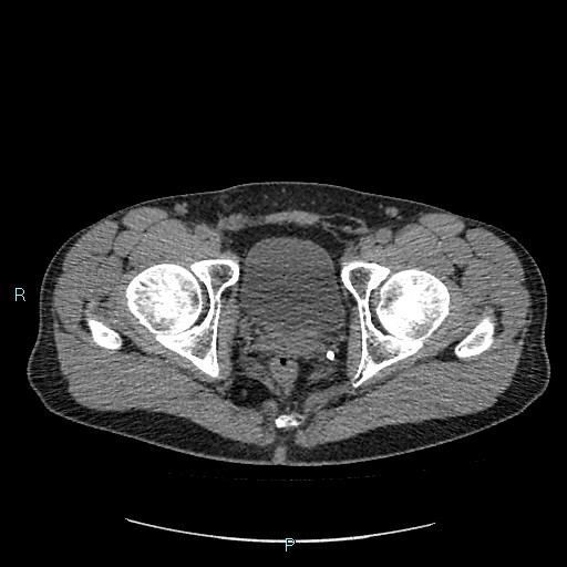 Adrenal cystic lymphangioma (Radiopaedia 83161-97534 Axial non-contrast 95).jpg
