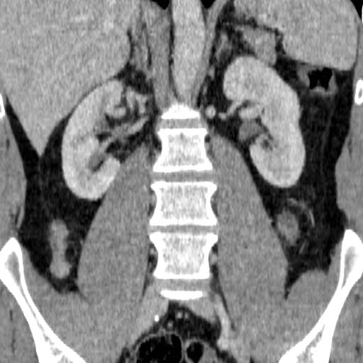 File:Adrenal glands (normal CT anatomy) (Radiopaedia 16570-105725 Coronal 7).jpg