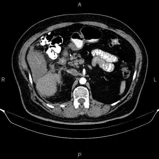 Adrenal hemorrhage (Radiopaedia 62622-70916 Axial C+ arterial phase 140).jpg