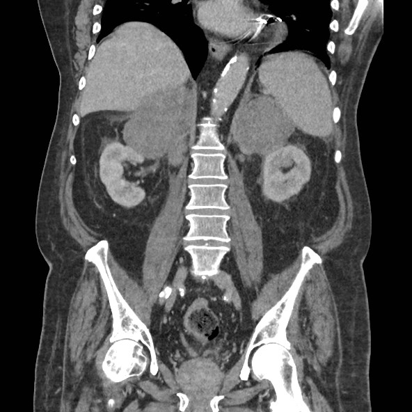 Adrenal lymphoma (Radiopaedia 84145-99415 Coronal C+ portal venous phase 55).jpg
