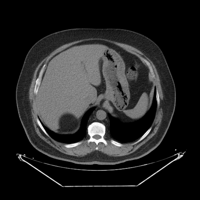 Adrenal myelolipoma (Radiopaedia 26278-26407 Axial non-contrast 10).jpg