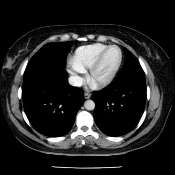 Adrenal myelolipoma (Radiopaedia 43401-46759 Axial C+ portal venous phase 2).jpg