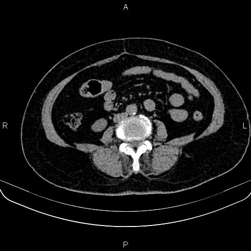 Adrenal myelolipoma (Radiopaedia 82742-96986 Axial non-contrast 95).jpg