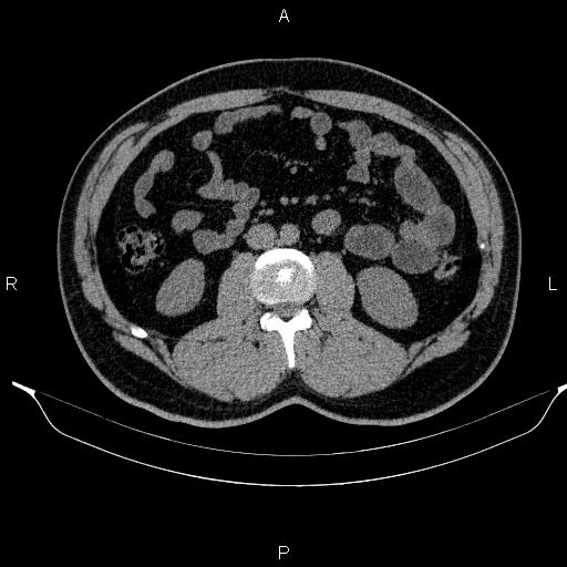 Adrenal myelolipoma (Radiopaedia 84321-99619 Axial non-contrast 56).jpg