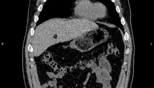 Adrenal myelolipoma (Radiopaedia 84321-99619 Coronal non-contrast 15).jpg