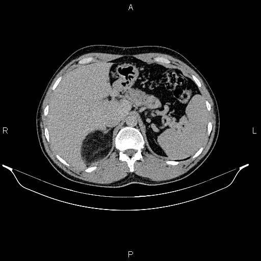 Adrenal myelolipoma (Radiopaedia 87794-104246 Axial renal excretory phase 24).jpg