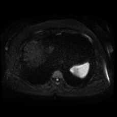 File:Adrenal myelolipoma - MRI (Radiopaedia 83249-97646 Axial DWI 1).jpg