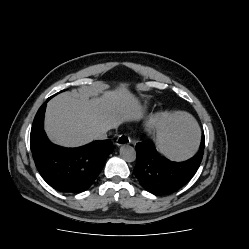 Adrenal myelolipoma and beaver tail liver (Radiopaedia 86201-102193 Axial non-contrast 40).jpg