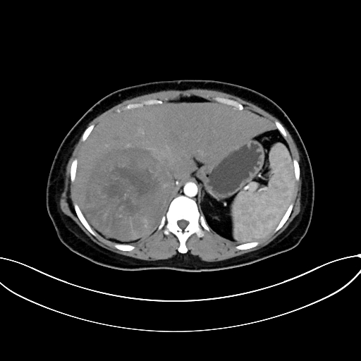 File:Adrenocortical carcinoma (Radiopaedia 87281-103569 Axial C+ arterial phase 22).jpg