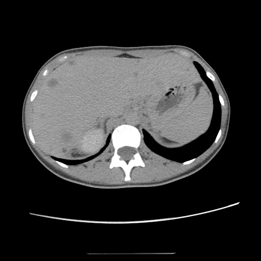 Adult polycystic kidney disease (Radiopaedia 48845-53876 Axial renal excretory phase 26).jpg