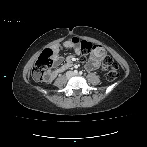 Adult transient intestinal intussusception (Radiopaedia 34853-36310 Axial C+ portal venous phase 55).jpg