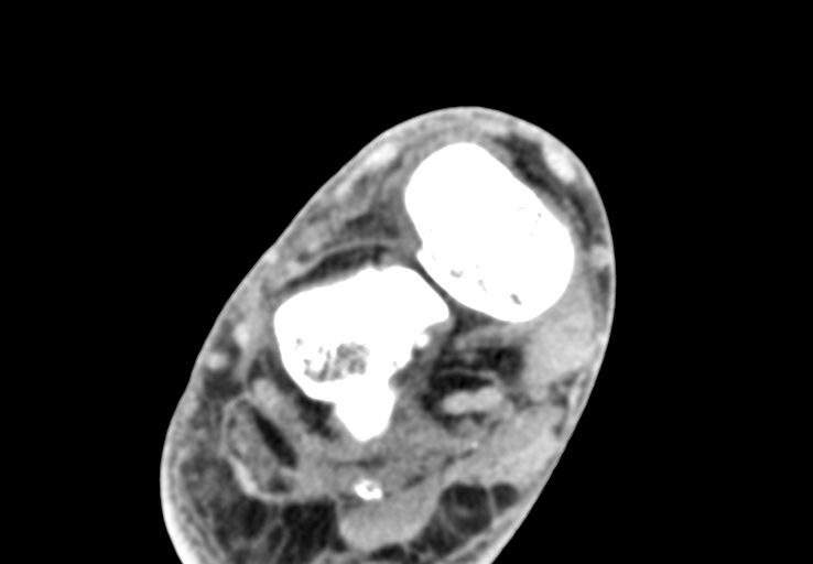 File:Advanced osteomyelitis due to open metatarsal fracture (Radiopaedia 83891-99095 Axial non-contrast 15).jpg