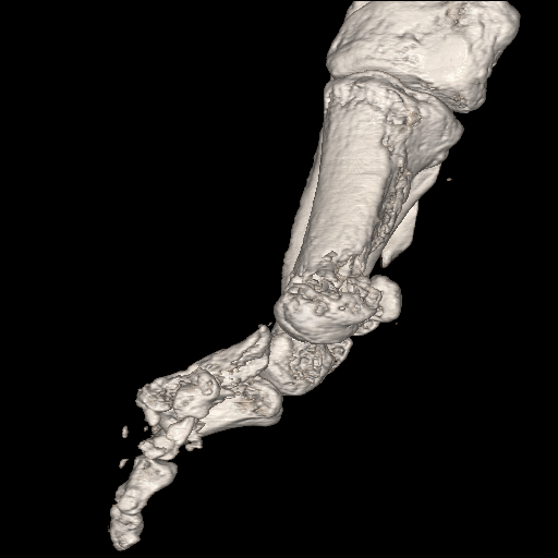 File:Advanced osteomyelitis due to open metatarsal fracture (Radiopaedia 83891-99095 VRT 5).jpg