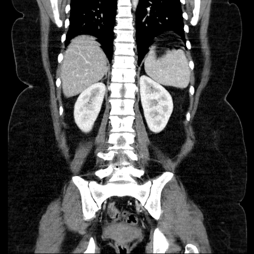 File:Afferent loop syndrome - secondary to incarcerated trocar site hernia (Radiopaedia 82959-97305 Coronal C+ portal venous phase 106).jpg