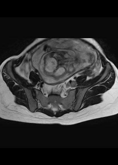 File:Aggressive angiomyxoma of the pelvis and perineum (Radiopaedia 59162-66479 Axial T2 21).jpg