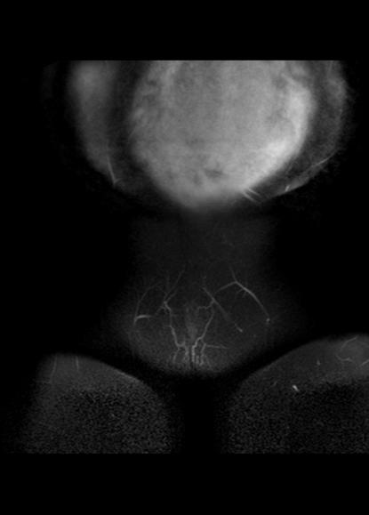 File:Aggressive angiomyxoma of the pelvis and perineum (Radiopaedia 59162-66479 Coronal T2 fat sat 1).jpg