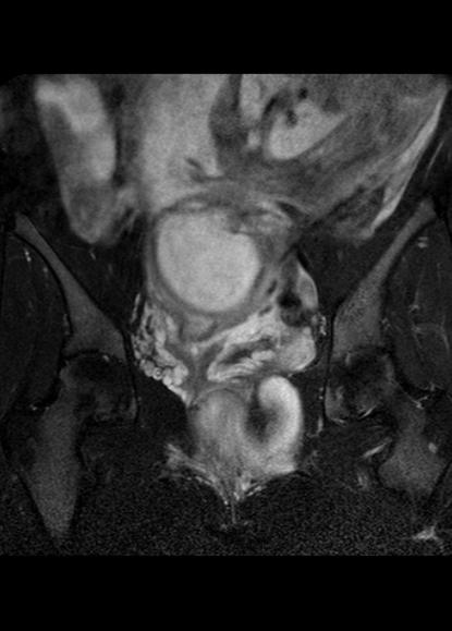 File:Aggressive angiomyxoma of the pelvis and perineum (Radiopaedia 59162-66479 Coronal T2 fat sat 14).jpg