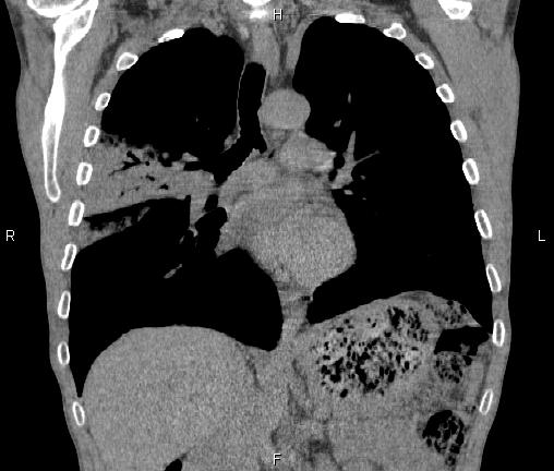 Air bronchogram in pneumonia (Radiopaedia 85719-101512 Coronal non-contrast 30).jpg