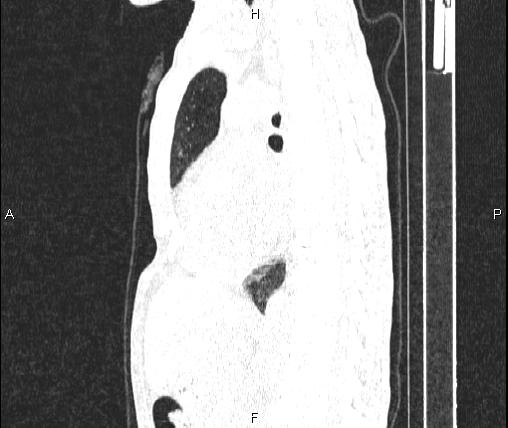 Air bronchogram in pneumonia (Radiopaedia 85719-101512 Sagittal lung window 52).jpg