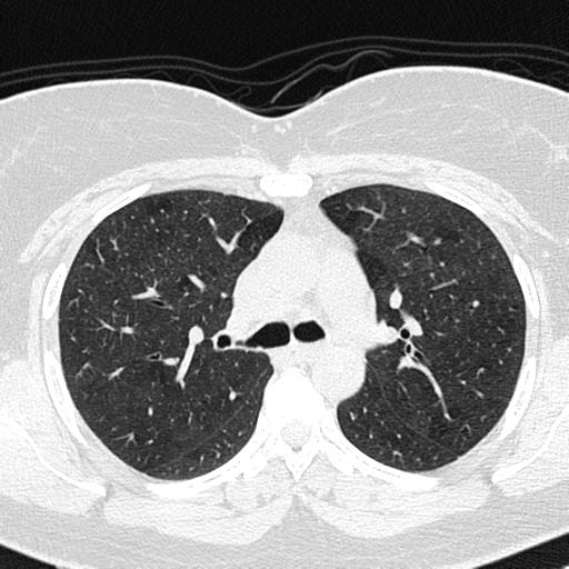 Air trapping in small airway disease (Radiopaedia 61685-69694 Axial lung window 61).jpg