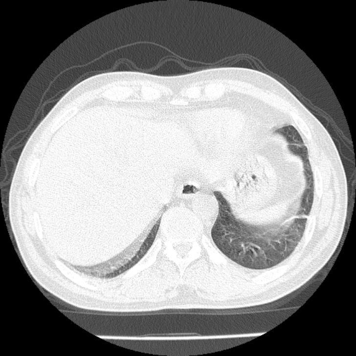 Airway foreign body in adult (Radiopaedia 85907-101779 Axial lung window 163).jpg