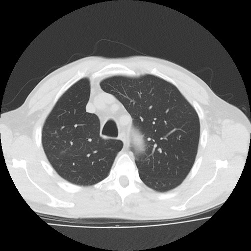 Allergic bronchopulmonary aspergillosis (ABPA) (Radiopaedia 60594-68313 Axial lung window 14).jpg