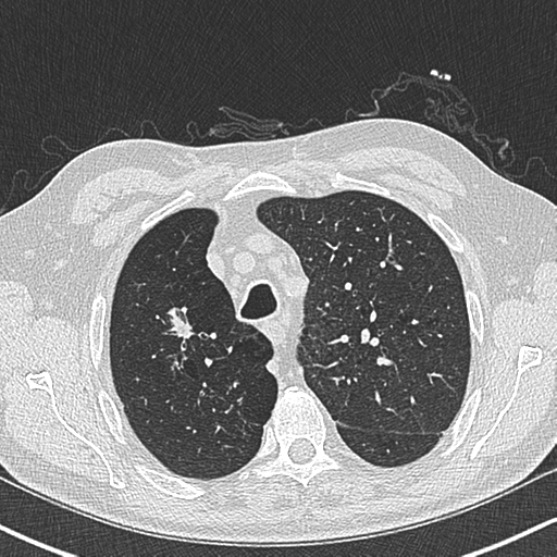 Allergic bronchopulmonary aspergillosis (Radiopaedia 44760-48571 Axial lung window 17).png