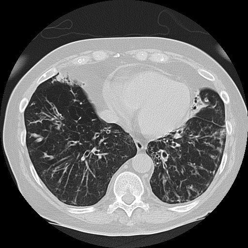Alpha-1-antitrypsin deficiency (Radiopaedia 72058-82557 Axial lung window 52).jpg