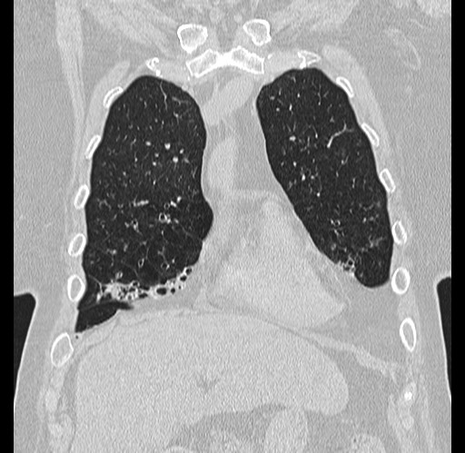 File:Alpha-1-antitrypsin deficiency (Radiopaedia 72058-82557 Coronal lung window 11).jpg